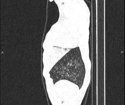 Air bronchogram in pneumonia (Radiopaedia 85719-101512 Sagittal lung window 10).jpg