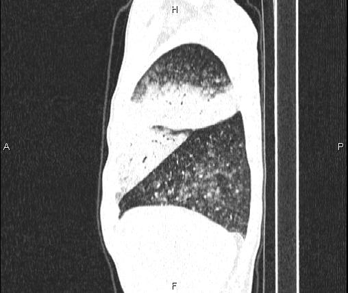 Air bronchogram in pneumonia (Radiopaedia 85719-101512 Sagittal lung window 17).jpg