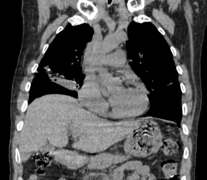 Airway foreign body in adult (Radiopaedia 85907-101779 Coronal liver window 102).jpg