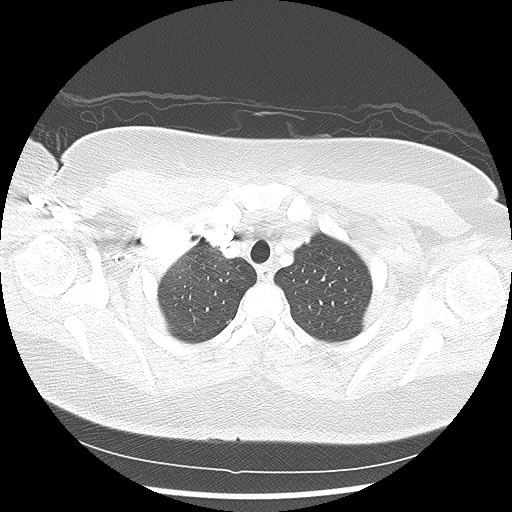Alveolar soft part sarcoma - right leg (Radiopaedia 59432-67091 Axial lung window 18).jpg