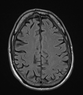 File:Alzheimer's disease- with apraxia (Radiopaedia 54763-61011 Axial FLAIR 20).png