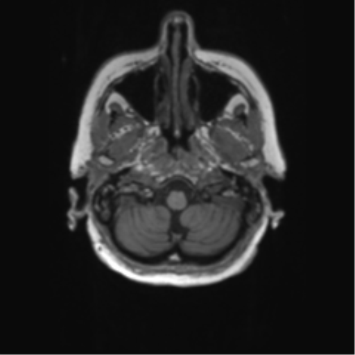 File:Alzheimer's disease (Radiopaedia 42658-45802 Axial T1 133).png