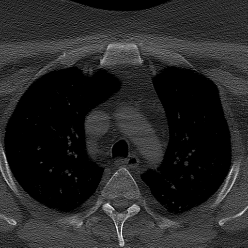 Ameloblastoma (Radiopaedia 38520-40623 Axial bone window 89).png