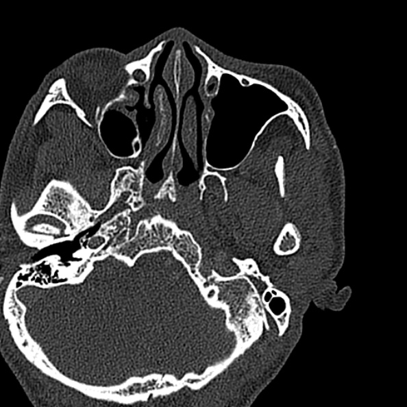 Ameloblastoma (Radiopaedia 51921-57766 Axial bone window 143).jpg