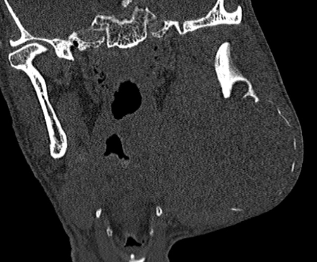 Ameloblastoma (Radiopaedia 51921-57766 Coronal bone window 168).jpg