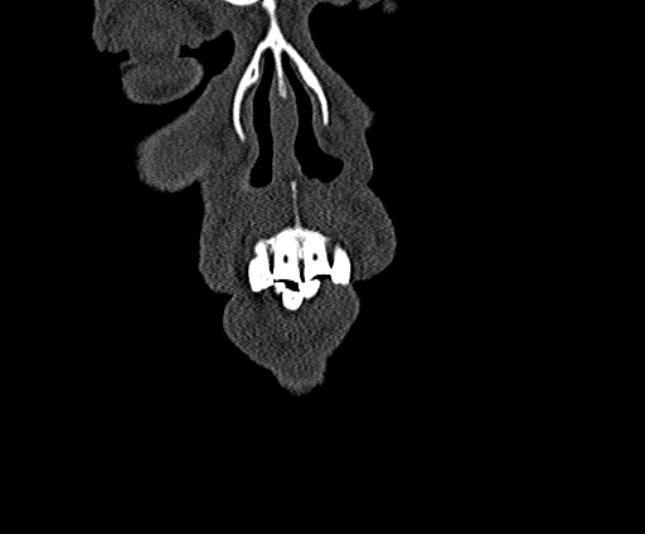 Ameloblastoma (Radiopaedia 51921-57766 Coronal bone window 5).jpg