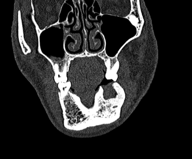 Ameloblastoma (Radiopaedia 51921-57766 Coronal bone window 59).jpg