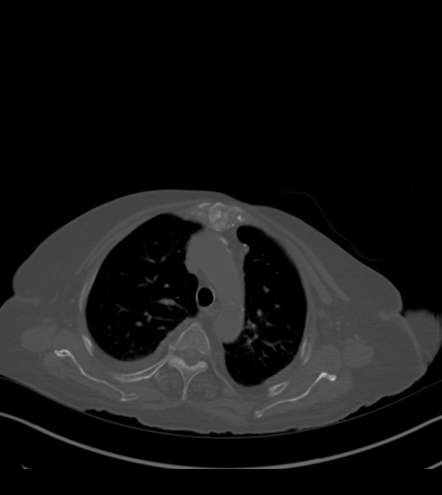 Amiodarone deposition in the liver (Radiopaedia 77587-89780 Axial bone window 24).jpg