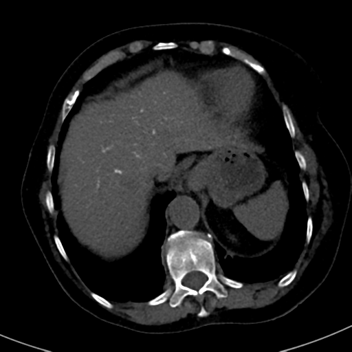 File:Ampullary adenocarcinoma (Radiopaedia 34013-35241 AXIAL THICK 12).png