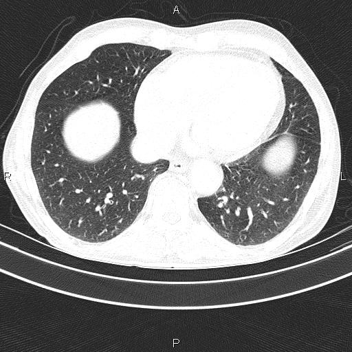 Ampullary adenocarcinoma (Radiopaedia 86093-102033 Axial lung window 43).jpg