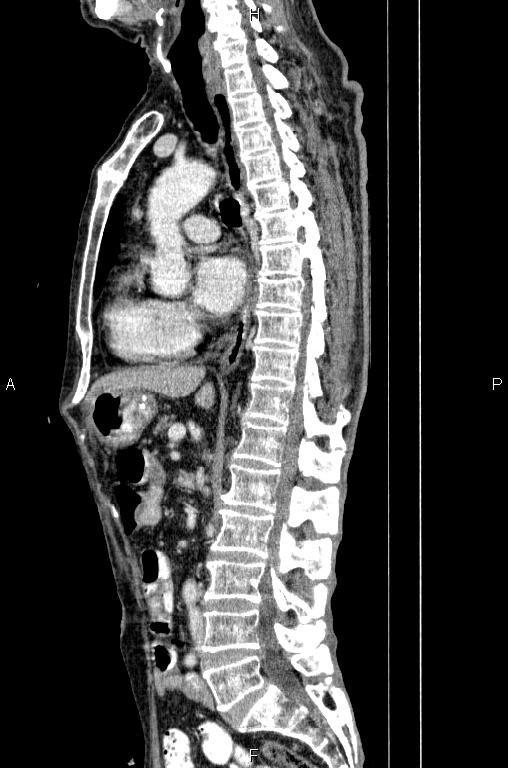 Ampullary adenocarcinoma (Radiopaedia 86093-102033 E 47).jpg