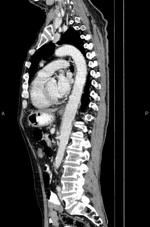 Ampullary adenocarcinoma (Radiopaedia 86093-102033 E 54).jpg
