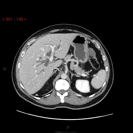 File:Ampullary carcinoma (Radiopaedia 56396-63056 C 27).jpg