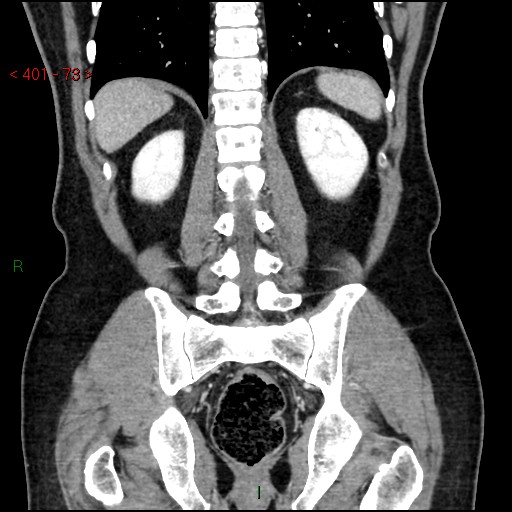Ampullary carcinoma (Radiopaedia 56396-63056 E 72).jpg