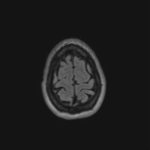 File:Anaplastic astrocytoma IDH mutant (Radiopaedia 50046-55341 Axial FLAIR 44).png
