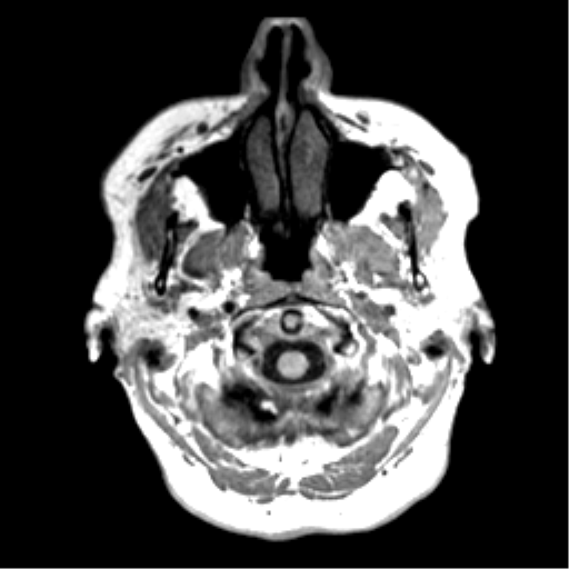 File:Anaplastic astrocytoma IDH wild-type (pseudoprogression) (Radiopaedia 42209-45277 Axial T1 4).png