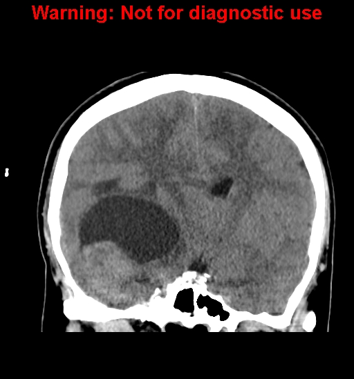 File:Anaplastic ganglioglioma (Radiopaedia 44921-48815 Coronal non-contrast 19).jpg