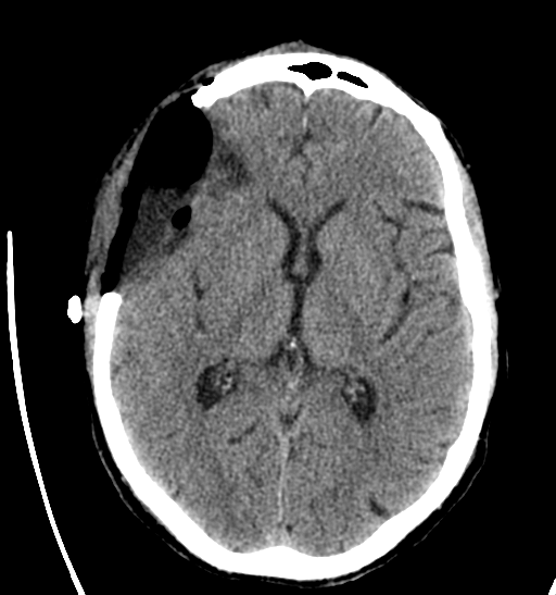 File:Anaplastic meningioma with recurrence (Radiopaedia 34452-35786 Axial non-contrast 17).png