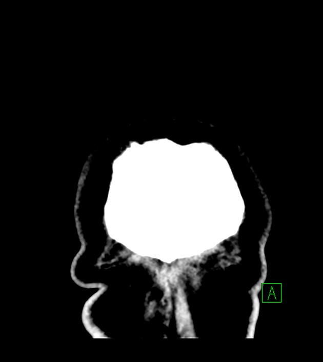 Anaplastic oligodendroglioma (Radiopaedia 79571-92753 Coronal non-contrast 69).jpg