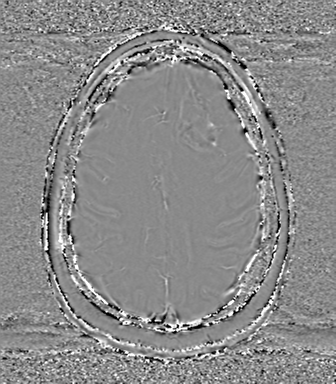 Anaplastic oligodendroglioma (Radiopaedia 83500-98599 Axial SWI - phase 64).png