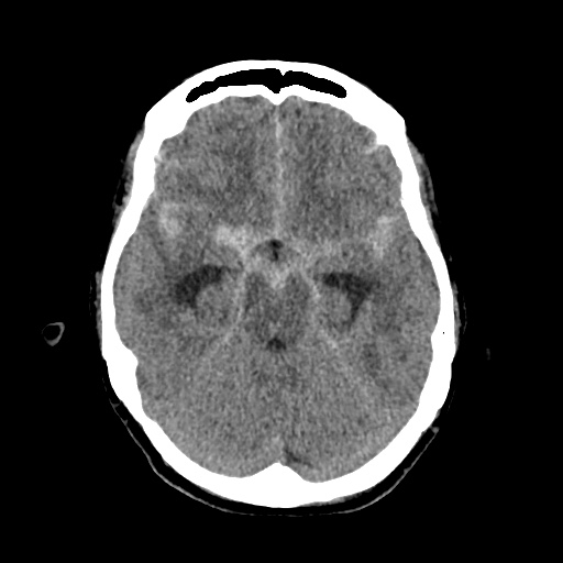 Aneursym related subarachnoid hemorrhage with hydrocephalus (Radiopaedia 45105-49083 Axial non-contrast 16).jpg