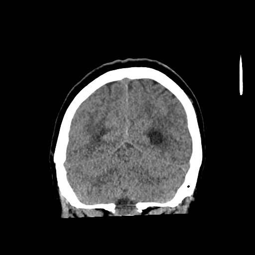 Aneursym related subarachnoid hemorrhage with hydrocephalus (Radiopaedia 45105-49083 Coronal non-contrast 52).jpg