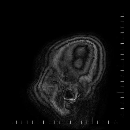 Aneurysm of posterior communicating artery (Radiopaedia 20188-20163 Sagittal T1 70).jpg