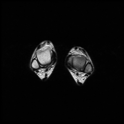 File:Aneurysmal bone cyst - tibia (Radiopaedia 22343-22367 Axial T2 17).jpg