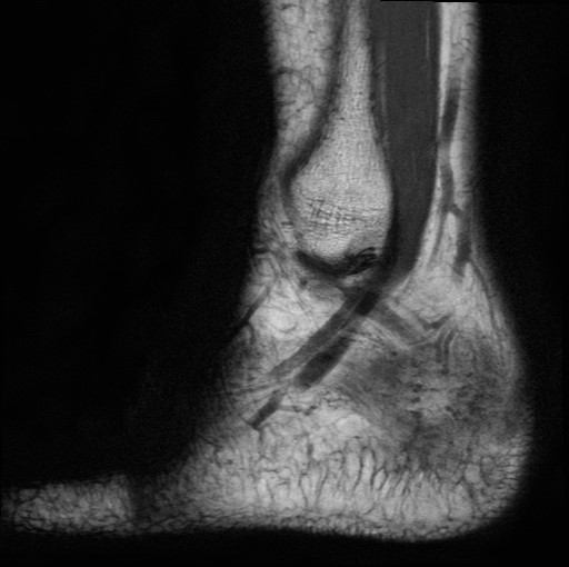 File:Aneurysmal bone cyst of the calcaneus (Radiopaedia 60669-68420 Sagittal T1 2).jpg