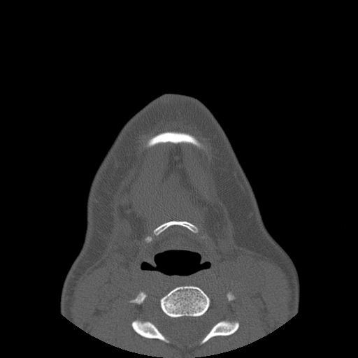 Aneurysmal bone cyst of the mandible (Radiopaedia 43280-46823 Axial bone window 4).jpg