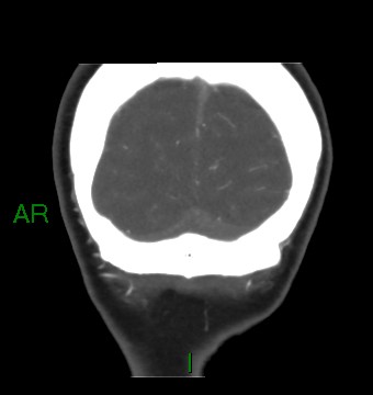 Aneurysmal subarachnoid hemorrhage with intra-axial extension (Radiopaedia 84371-99732 C 14).jpg