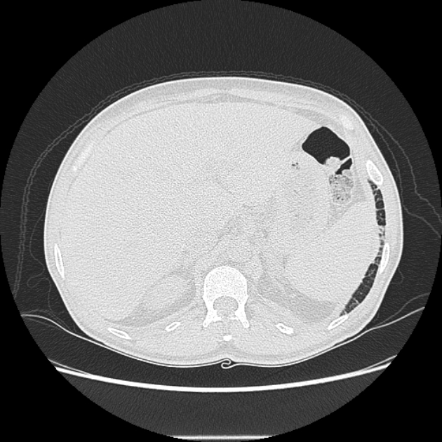 Angioinvasive aspergellosis (Radiopaedia 66995-76315 Axial lung window 51).jpg