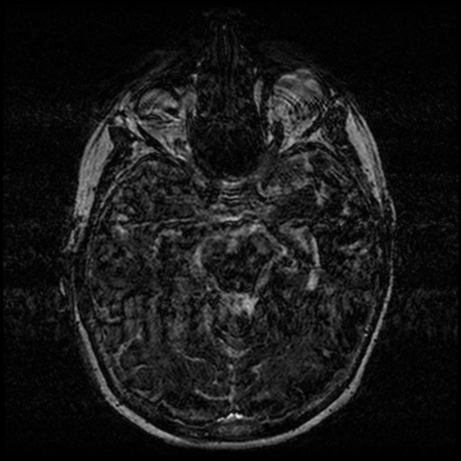 Angioinvasive aspergillosis in the pituitary fossa (Radiopaedia 39676-42010 Ax 3D FIESTA VOLUME 62).png