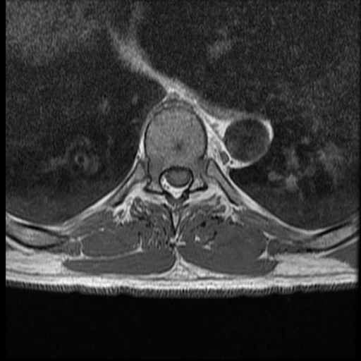 File:Angiolipoma - thoracic spine (Radiopaedia 28242-28479 Axial T1 3).jpg