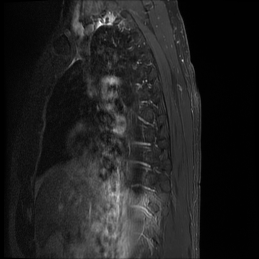 File:Angiolipoma - thoracic spine (Radiopaedia 28242-28479 E 14).jpg