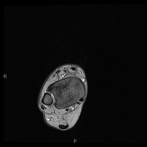 Ankle ganglion cyst (Radiopaedia 62809-71162 Axial Gradient Echo 76).jpg