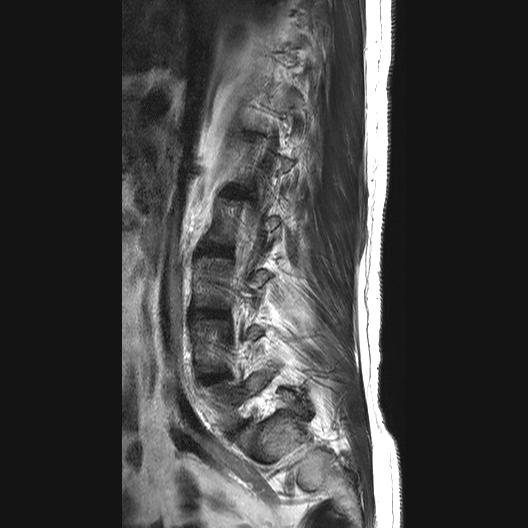 File:Ankylosing spondylitis with zygapophyseal arthritis (Radiopaedia 38433-40516 Sagittal T2 10).jpg