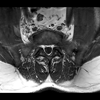File:Ankylosing spondylitis with zygapophyseal arthritis (Radiopaedia 38433-40517 B 1).jpg