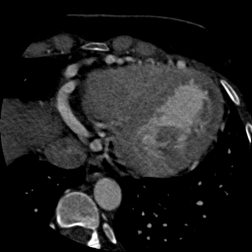 File:Anomalous left coronary artery from the pulmonary artery (ALCAPA) (Radiopaedia 40884-43586 A 68).jpg
