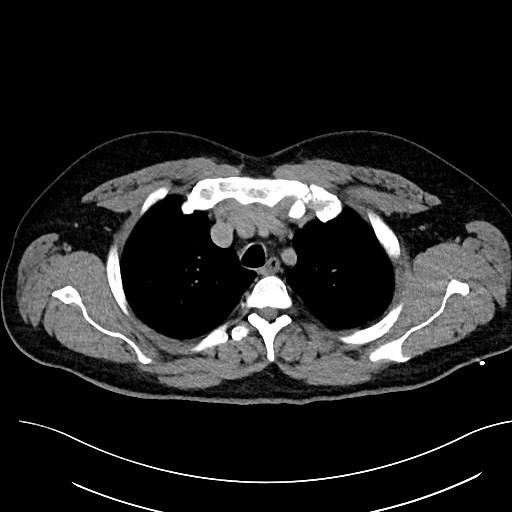 File:Anomalous origin of the left coronary artery with malignant course (Radiopaedia 77842-90126 Axial non-contrast 9).jpeg