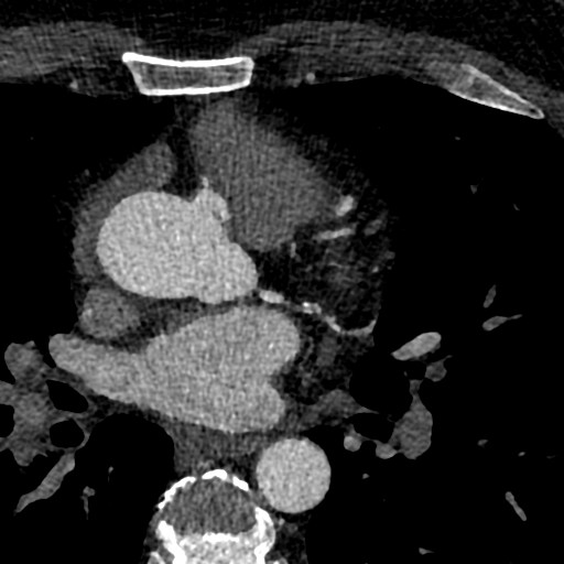 File:Anomalous origin of the left coronary artery with malignant course (Radiopaedia 77842-90126 C 41).jpeg