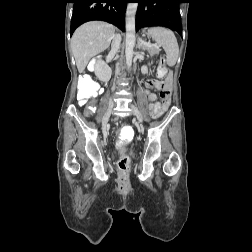File:Anorectal carcinoma (Radiopaedia 44413-48064 B 49).jpg