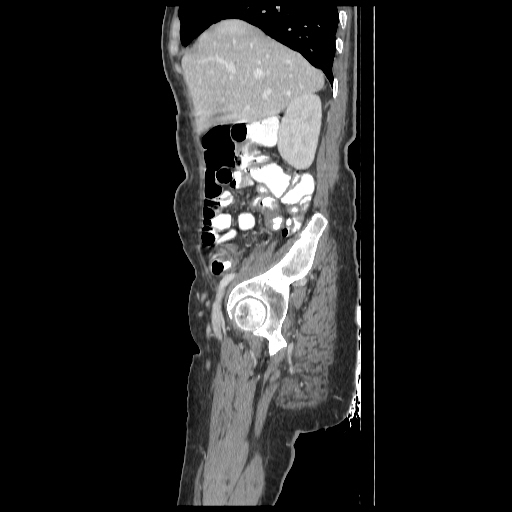 Anorectal carcinoma (Radiopaedia 44413-48064 C 23).jpg