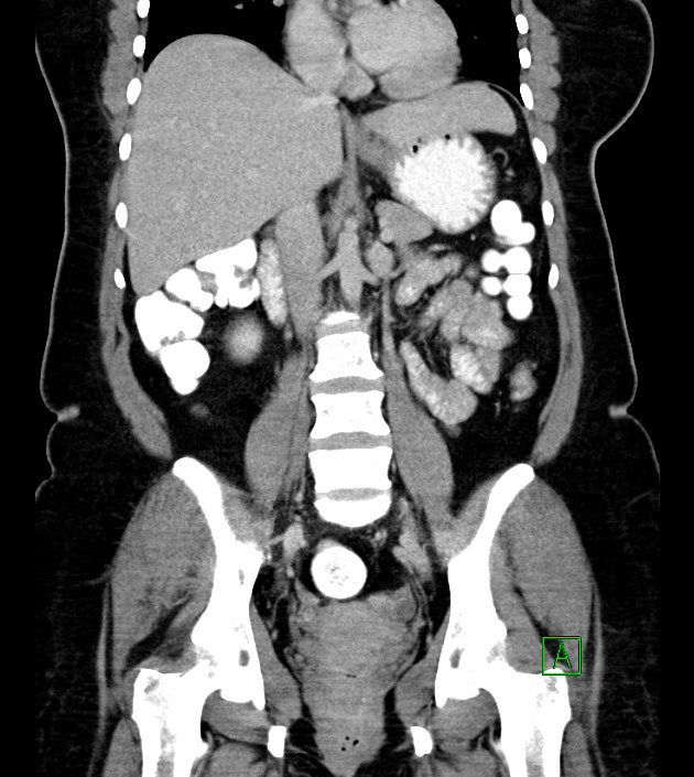 Anterior abdominal wall CSF pseudocyst (CSFoma) (Radiopaedia 79453-92571 B 32).jpg