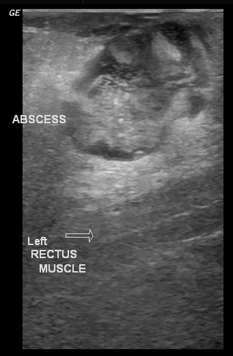 File:Anterior abdominal wall abscess (Radiopaedia 17732-17480 F 1).jpg