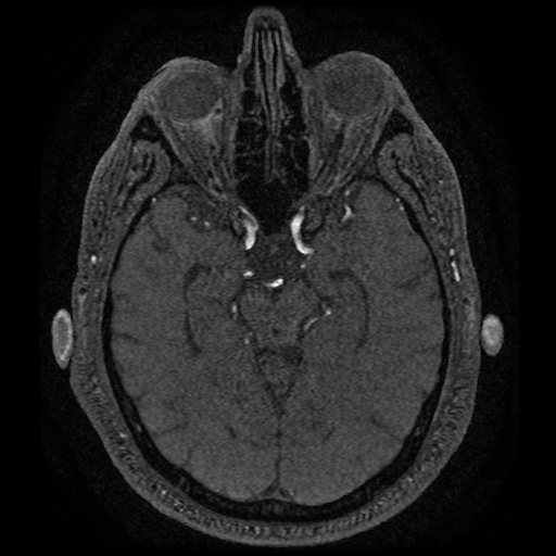 Anterior cerebral artery infarction (Radiopaedia 46794-51323 Axial MRA 76).jpg