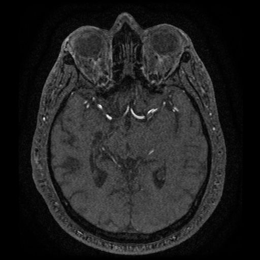 Anterior cerebral artery infarction (Radiopaedia 46794-51323 Axial MRA 91).jpg