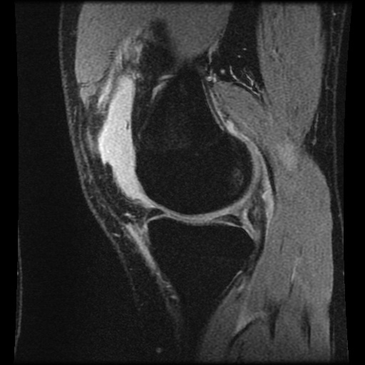 Anterior cruciate ligament tear (Radiopaedia 61500-69462 F 24).jpg