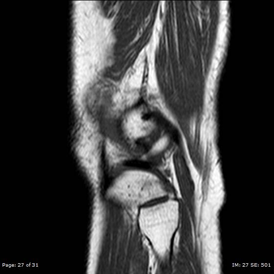 File:Anterior cruciate ligament tear (Radiopaedia 70783-80964 Sagittal T1 27).jpg