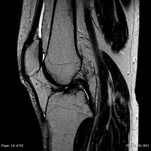 File:Anterior cruciate ligament tear (Radiopaedia 70783-80964 Sagittal T2 16).jpg